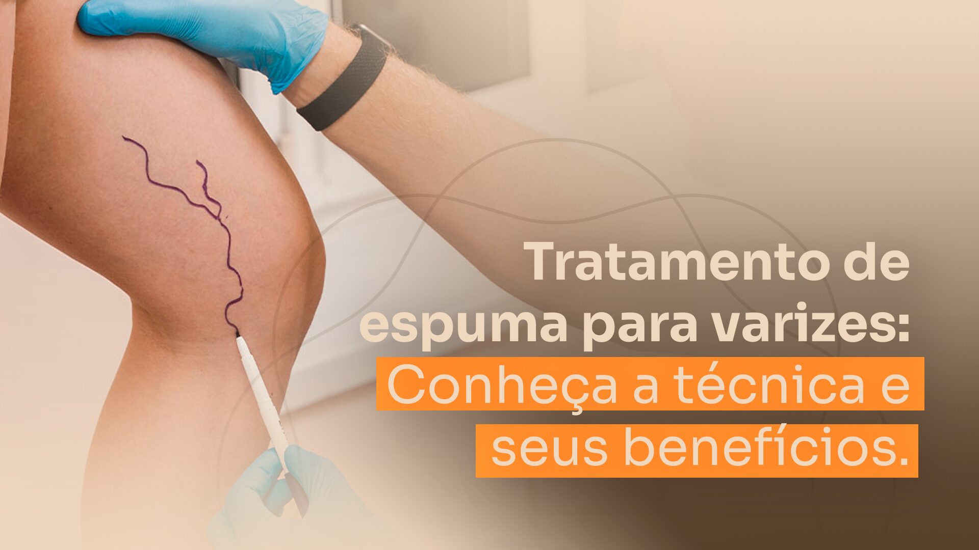 Espuma para varizes: conheça a técnica e seus benefícios